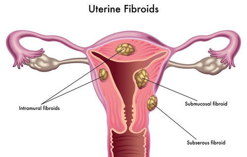 子宫肌瘤不用管 出现这4种情况,需另当别论