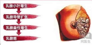 乳腺小叶增生吃什么药最好