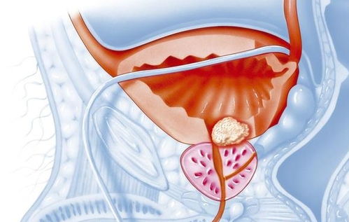 前列腺增生可以用什么药 汇总4类西药和9类中药,建议收藏