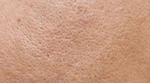 应对大面积毛孔粗大 本色肤雕与生殖激素的皮肤管理